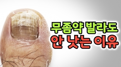 무좀약의 치료 효과를 높이는 방법
