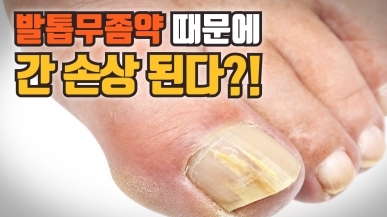 무좀약이 간경화를 일으킬 수도 있는 이유